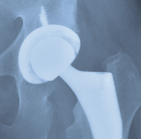 JREP: Hip Replacement Education