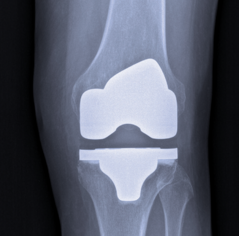 JREP: Knee Replacement Education