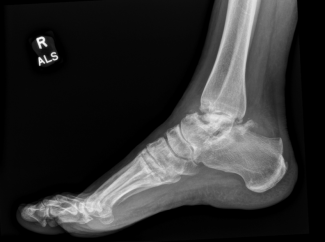 Figure 1A: Preoperative lateral X-ray of the ankle demonstrating collapse of the talus, with resultant ankle and subtalar joint arthritis.