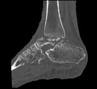 Figure 1B: Preoperative lateral sagittal CT scan of the ankle demonstrating collapse of the talus, with resultant ankle and subtalar joint arthritis.