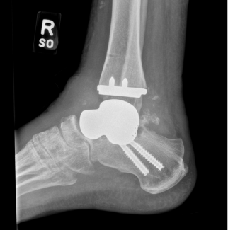 Figure 1C: Postoperative lateral X-ray of the ankle demonstrating a custom total talus replacement, ankle replacement and subtalar fusion.
