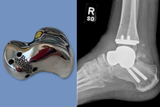 Dr. Toussaint uses 3D printing technology for total talus and ankle replacement surgery